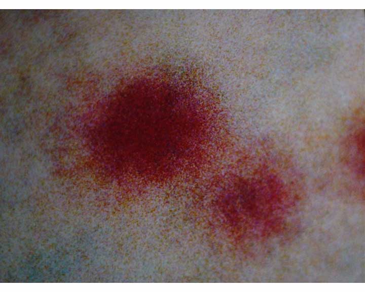 lesion
